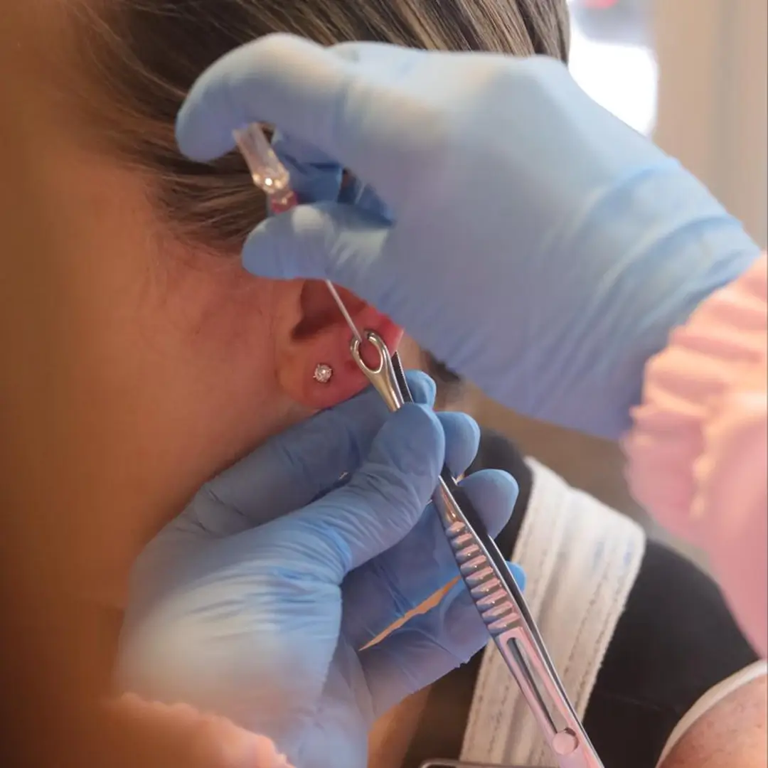 Close-up of needle and catheter ear piercing method